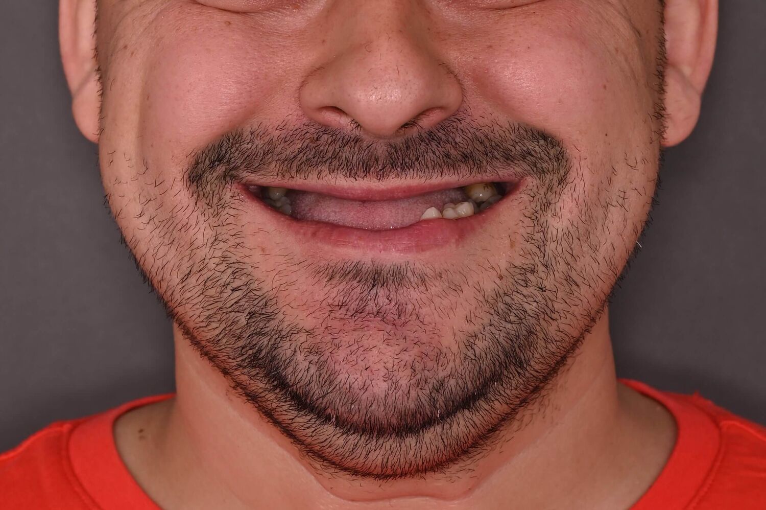 Pacient Clinica Dr. Alin Odor - Rezultat Implantologie